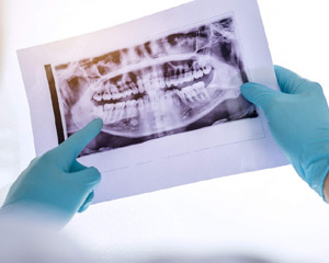 Digital X-Ray of dental patients mouth I teeth grinding burien WA
