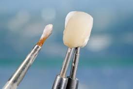 close up of porcelain veneer & cosmetic dental tool I burien dental clinic