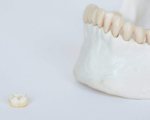 close up of dental crowns I burien dental clinic burien WA