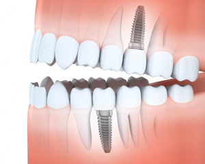 Dental implant placement l Burien Dental Clinic Burien WA
